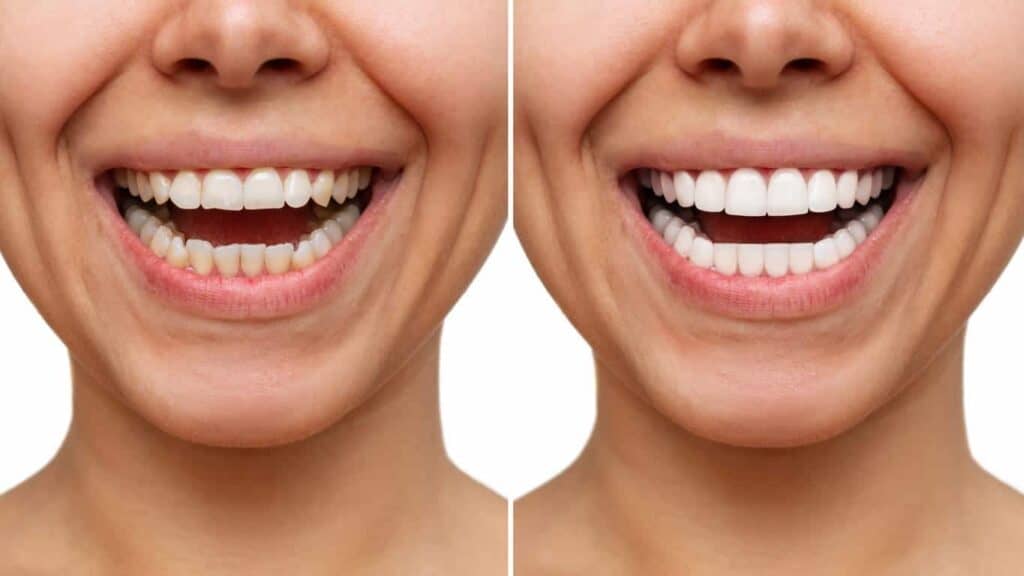 Before and after teeth whitening results. Wellingborough