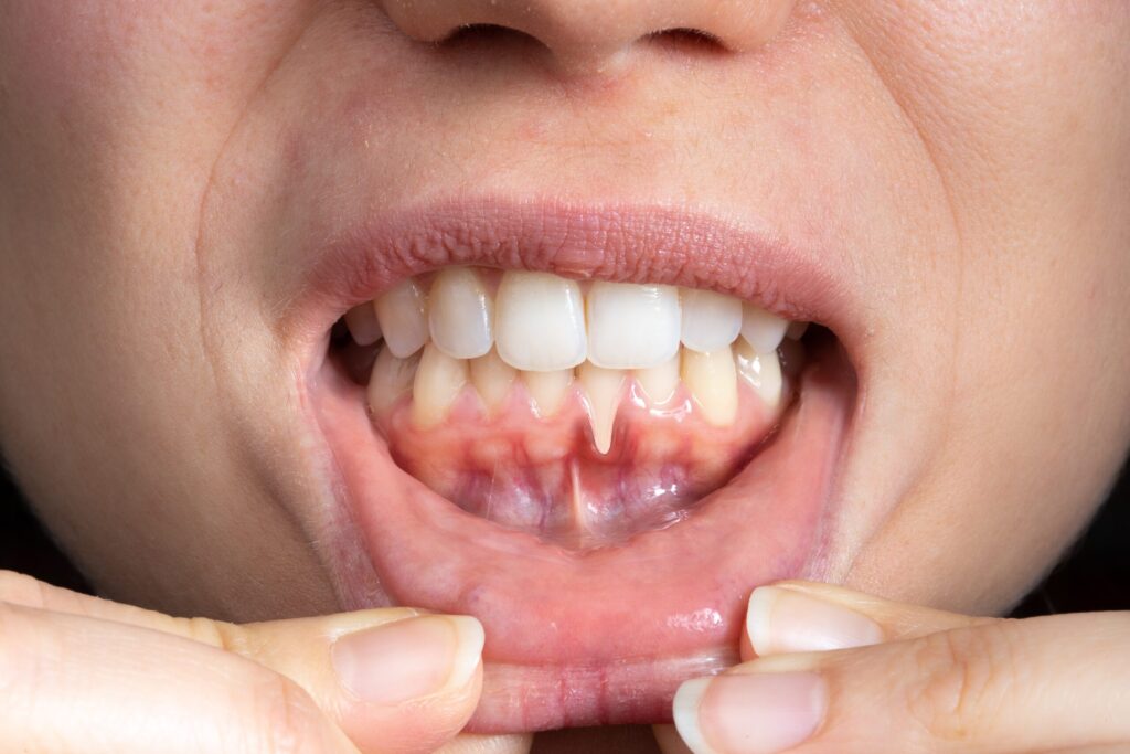 Preparing for teeth whitening with receding gums Wellingborough