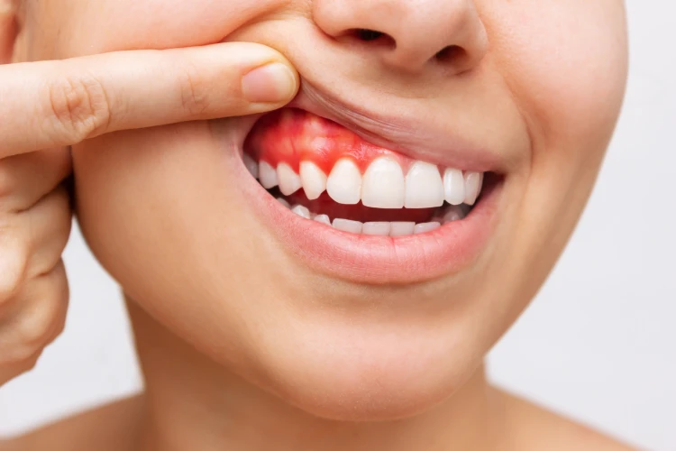 young women showing gum receding inflamation bleeding Wellingborough